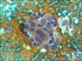 胸水找见腺癌细胞2图5
