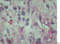 大家帮忙看看这个是宫颈肌瘤还是息肉？还有那些胞浆深染细胞是什么细胞？图15
