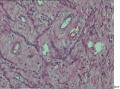 大家帮忙看看这个是宫颈肌瘤还是息肉？还有那些胞浆深染细胞是什么细胞？图9