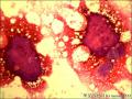 乳腺导管原位癌+小叶原位癌图3