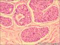 乳腺导管原位癌+小叶原位癌图20