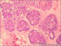 乳腺导管原位癌+小叶原位癌图16
