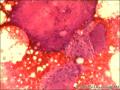 乳腺导管原位癌+小叶原位癌图2