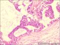 乳腺导管原位癌+小叶原位癌图21