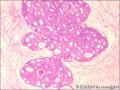 乳腺导管原位癌+小叶原位癌图14