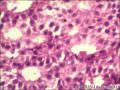 乳腺导管原位癌+小叶原位癌图25