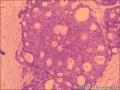 乳腺导管原位癌+小叶原位癌图8