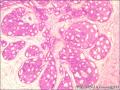 乳腺导管原位癌+小叶原位癌图13