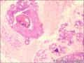 乳腺导管原位癌+小叶原位癌图11