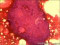 乳腺导管原位癌+小叶原位癌图1