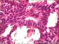 乳腺导管原位癌+小叶原位癌图27