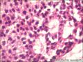 乳腺导管原位癌+小叶原位癌图26