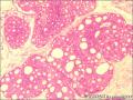 乳腺导管原位癌+小叶原位癌图17