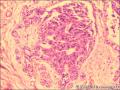 乳腺导管原位癌+小叶原位癌图18
