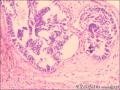 乳腺导管原位癌+小叶原位癌图22