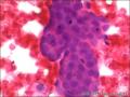 乳腺导管原位癌+小叶原位癌图7