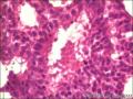 乳腺导管原位癌+小叶原位癌图28