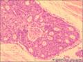 乳腺导管原位癌+小叶原位癌图9