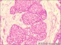 乳腺导管原位癌+小叶原位癌图15