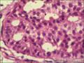 乳腺导管原位癌+小叶原位癌图23