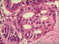 乳腺导管原位癌+小叶原位癌图24