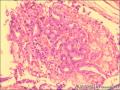 乳腺导管原位癌+小叶原位癌图19
