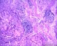 胃窦溃疡 临近溃疡浆膜层淋巴结异型腺体浸润 癌转移吗？图8