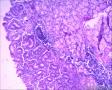 胃窦溃疡 临近溃疡浆膜层淋巴结异型腺体浸润 癌转移吗？图5