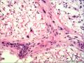 肾周肿物，再传石蜡与免疫组化图14