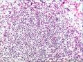 肾周肿物，再传石蜡与免疫组化图5