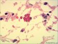 肾周肿物，再传石蜡与免疫组化图31