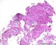 纤支镜肺活检1：腺癌或鳞癌？含IHC图1