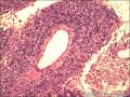 肠系膜肿物图14