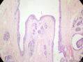 经典病例学习-乳腺不同原位癌共存图10