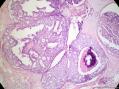 经典病例学习-乳腺不同原位癌共存图7