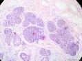 经典病例学习-乳腺不同原位癌共存图6