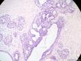 经典病例学习-乳腺不同原位癌共存图15