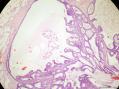 经典病例学习-乳腺不同原位癌共存图11