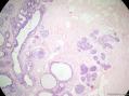 经典病例学习-乳腺不同原位癌共存图14