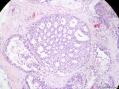 经典病例学习-乳腺不同原位癌共存图17