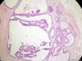 经典病例学习-乳腺不同原位癌共存图5