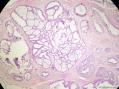 经典病例学习-乳腺不同原位癌共存图13