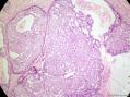 经典病例学习-乳腺不同原位癌共存图8