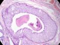 经典病例学习-乳腺不同原位癌共存图18