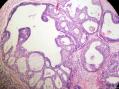 经典病例学习-乳腺不同原位癌共存图9