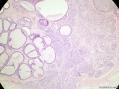 经典病例学习-乳腺不同原位癌共存图4