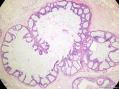 经典病例学习-乳腺不同原位癌共存图1