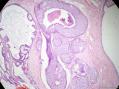 经典病例学习-乳腺不同原位癌共存图12