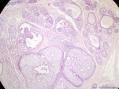 经典病例学习-乳腺不同原位癌共存图3