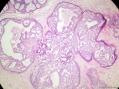 经典病例学习-乳腺不同原位癌共存图2